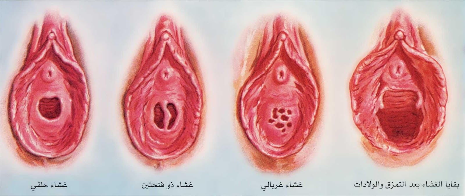 ترقيع البكاره في المنزل , هل يمكن ترقيع غشاء البكاره بالمنزل