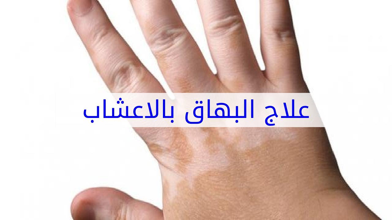 علاج البهاق بالاعشاب , تعرف على اروع علاجات الطب البديل