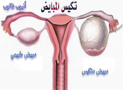 تكيس المبايض اسبابه وعلاجه 11193