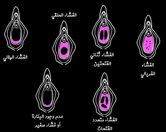 ترقيع البكاره في المنزل - هل يمكن ترقيع غشاء البكاره بالمنزل 4243 7