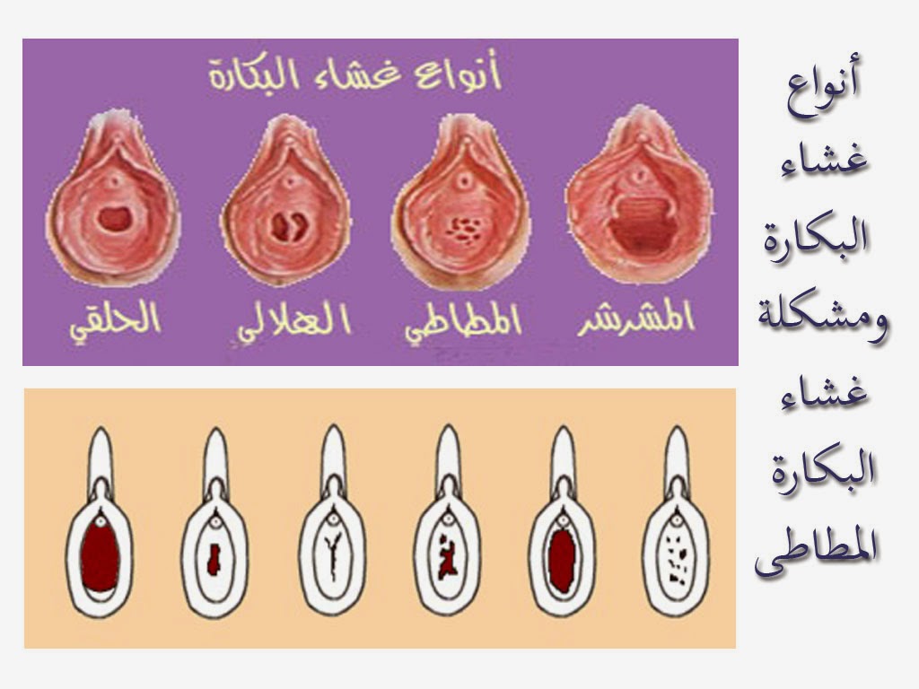 ترقيع البكاره في المنزل - هل يمكن ترقيع غشاء البكاره بالمنزل 4243 12