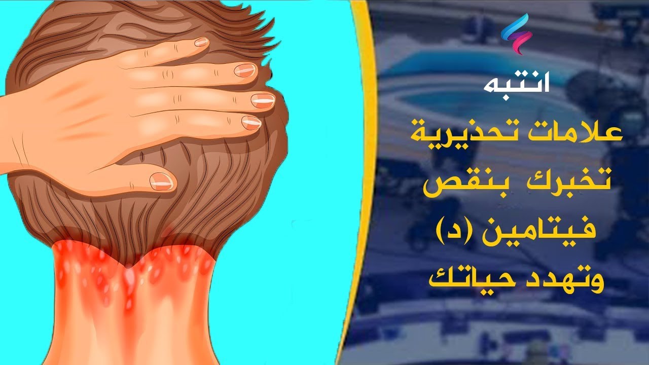 ماهي اعراض نقص فيتامين د- يجب ان تعرف هذه الاعراض 3697 3