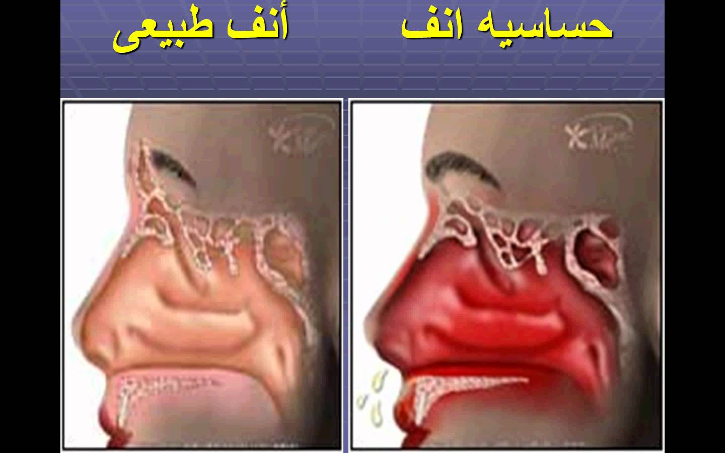 اعراض حساسية الانف - اسباب حساسية الانف وعلاجها 3035 3