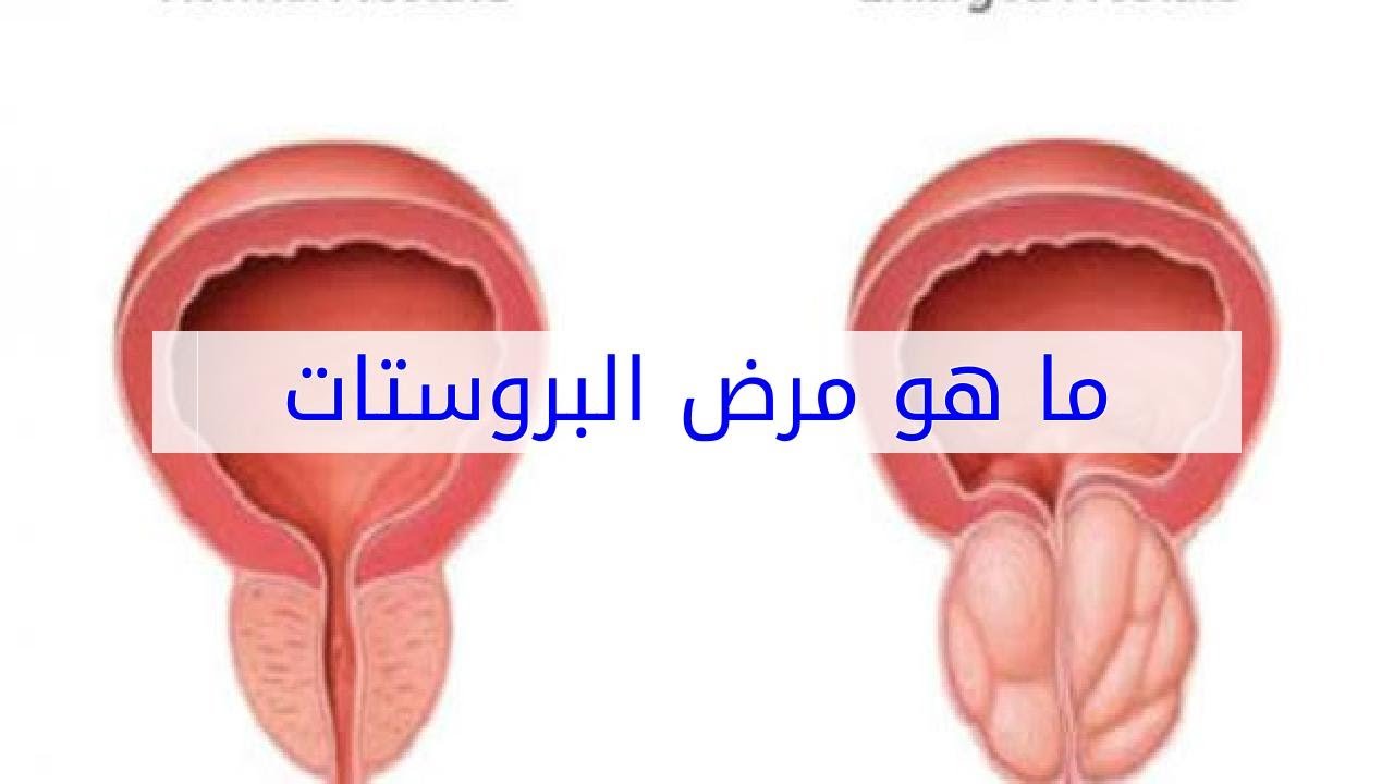 مرض البروستات 436 2