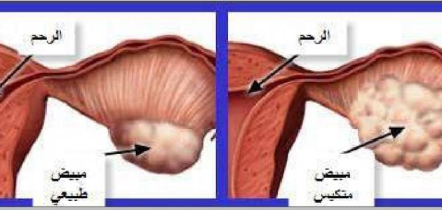 اعراض تكيس المبايض , اسباب تكيس المبايض وعلاجه