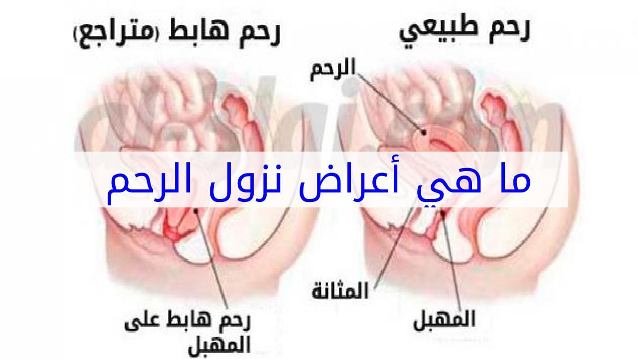 بالصور نزول الرحم - الرحم الهابط ومعرفته بالصور 12493 2