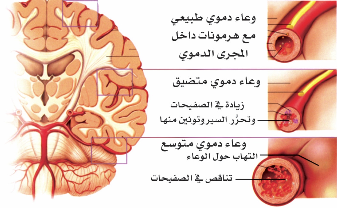 مرض الشقيقة , ما هو مرض الشقيقه و الطرق لاجتناب نوبته