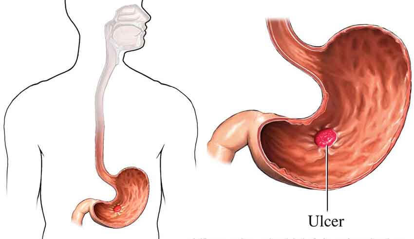 اعراض قرحة المعدة , ما هي اسباب واعراض قرحة المعدة