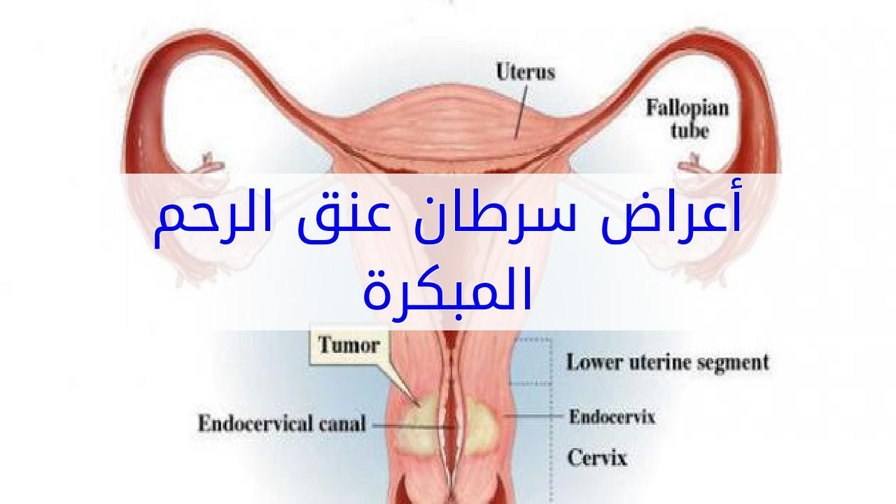 اعراض سرطان الرحم , تعرف على الاعراض والوقاية من هذا المرض