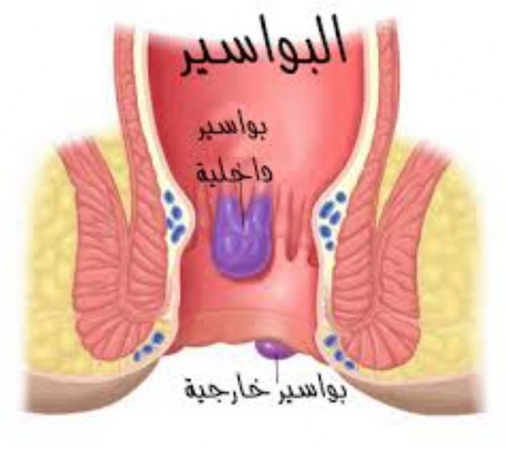 اسباب البواسير , ما هي البواسير و اسباب وجودها