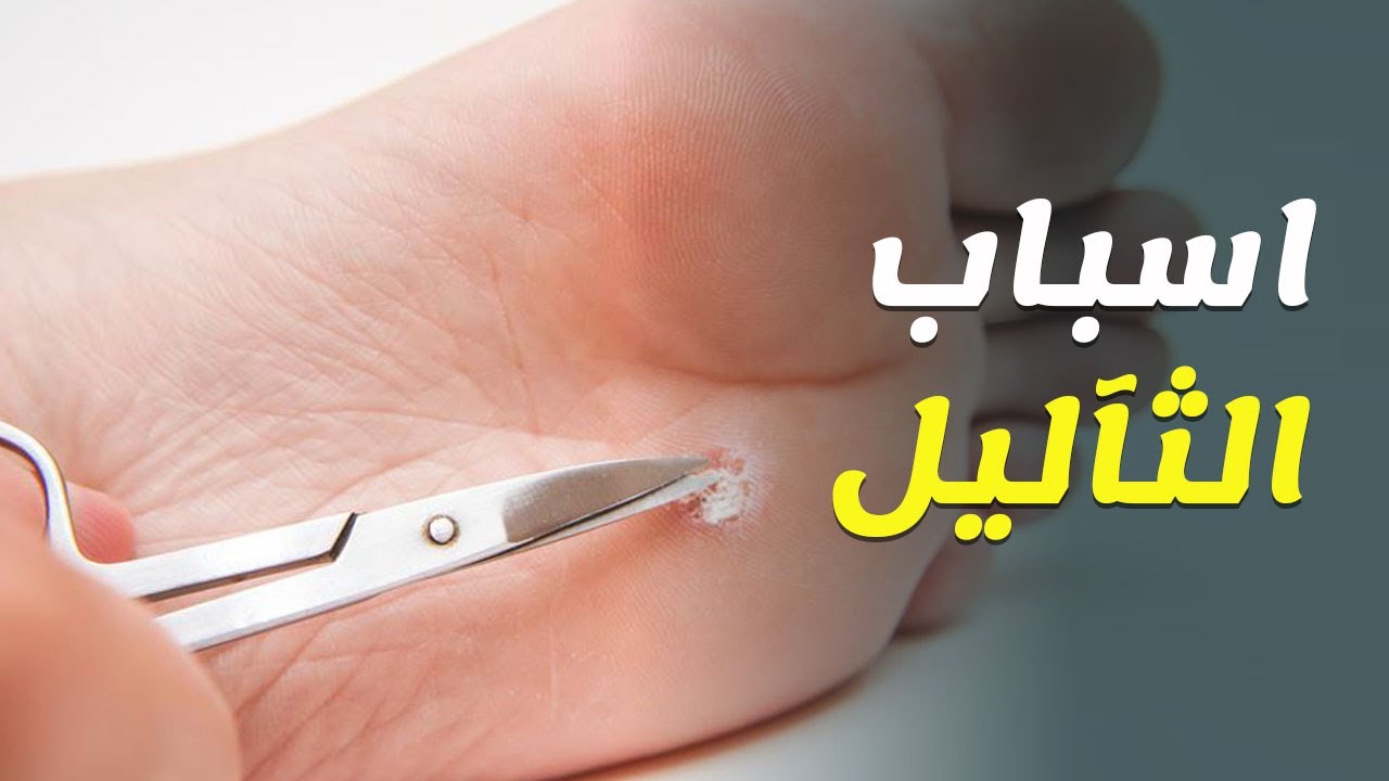 علاج الثاليل - طرق طبيعية لعلاج الثاليل 5760 5