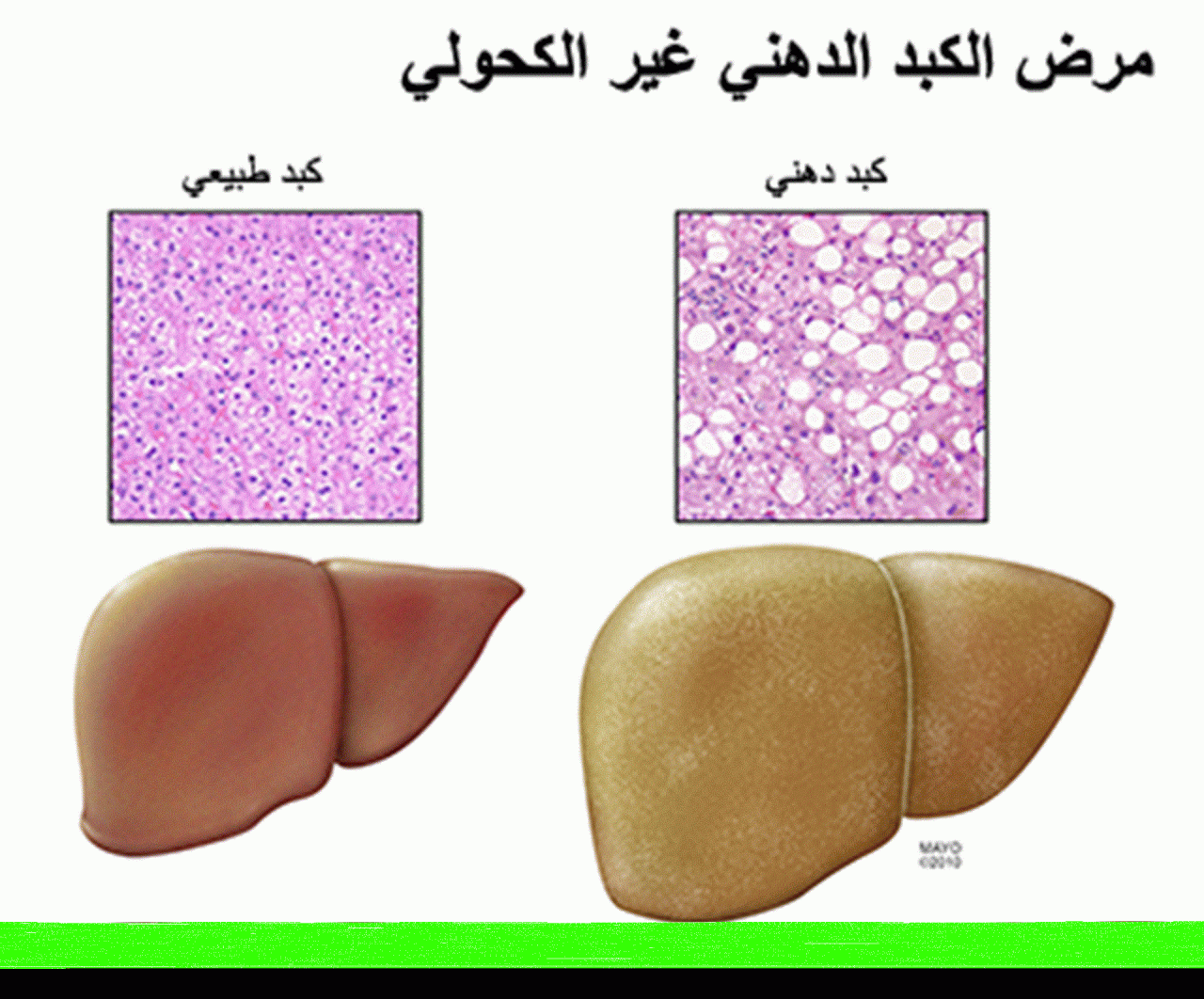 مرض الكبد الوبائي- علاج مرض الكبد 274