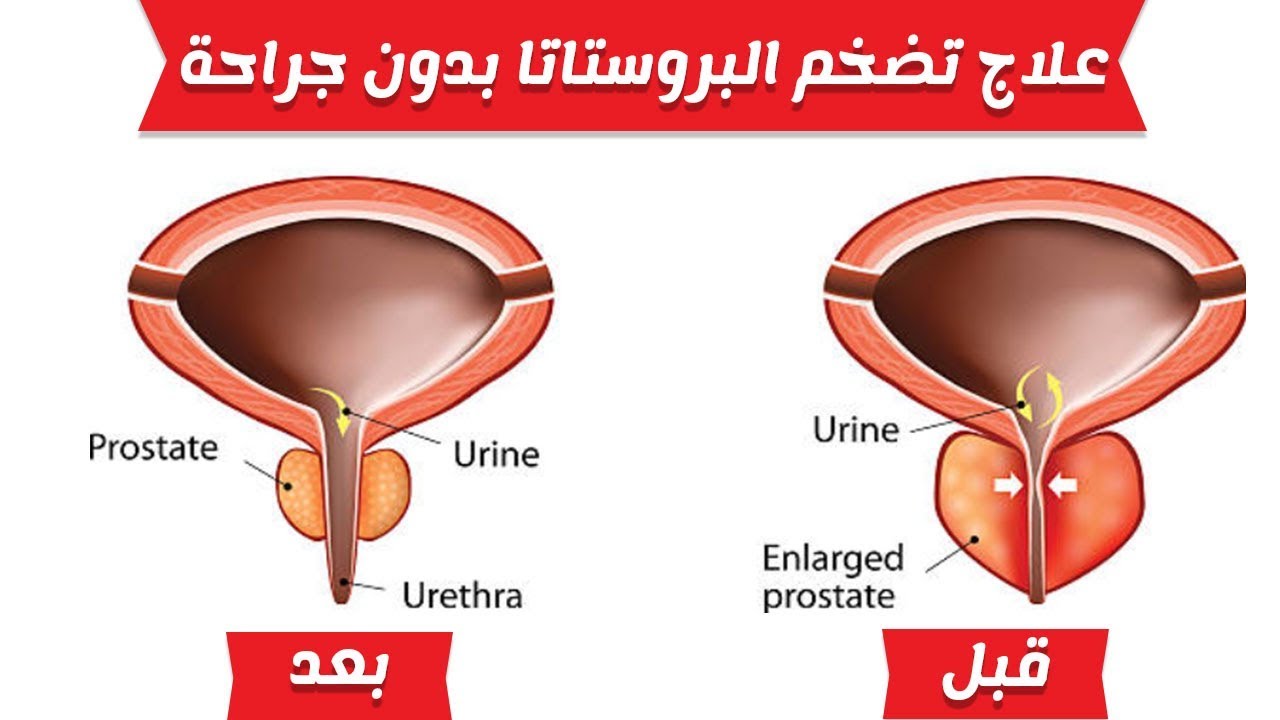 اسباب تضخم البروستاتا 2029