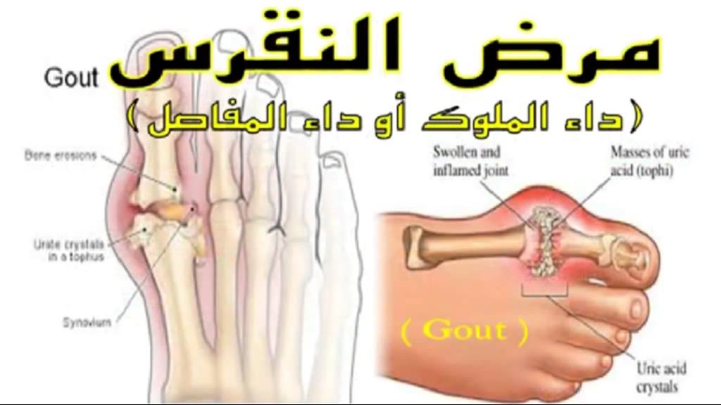 علاج النقرس بالاعشاب - افضل الاعشاب التي يمكن تناولها لعلاج النقرس 4592 3