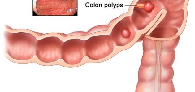 مرض القولون , تعرف على مرض القولون واعراضه