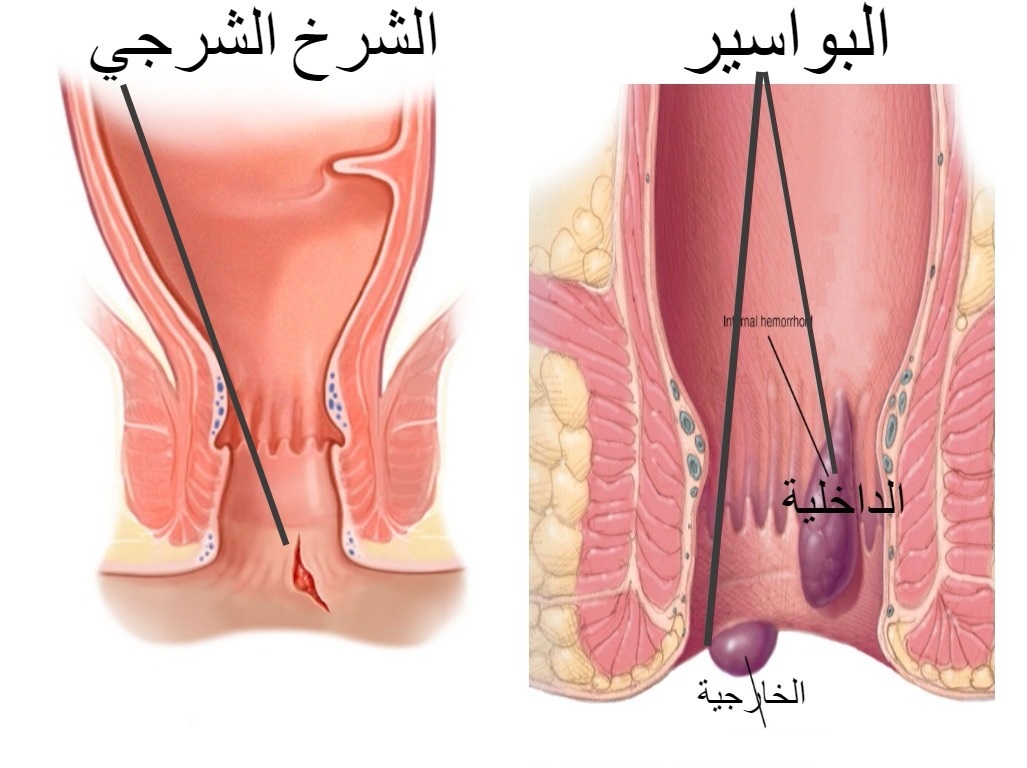 علاج البواسير 5097 1