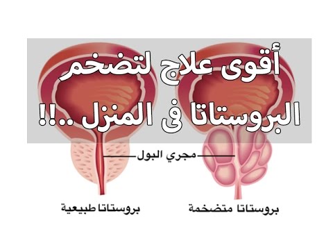 علاج تضخم البروستاتا - علاج تضخم البروستاتا بالاعشاب 2726 3