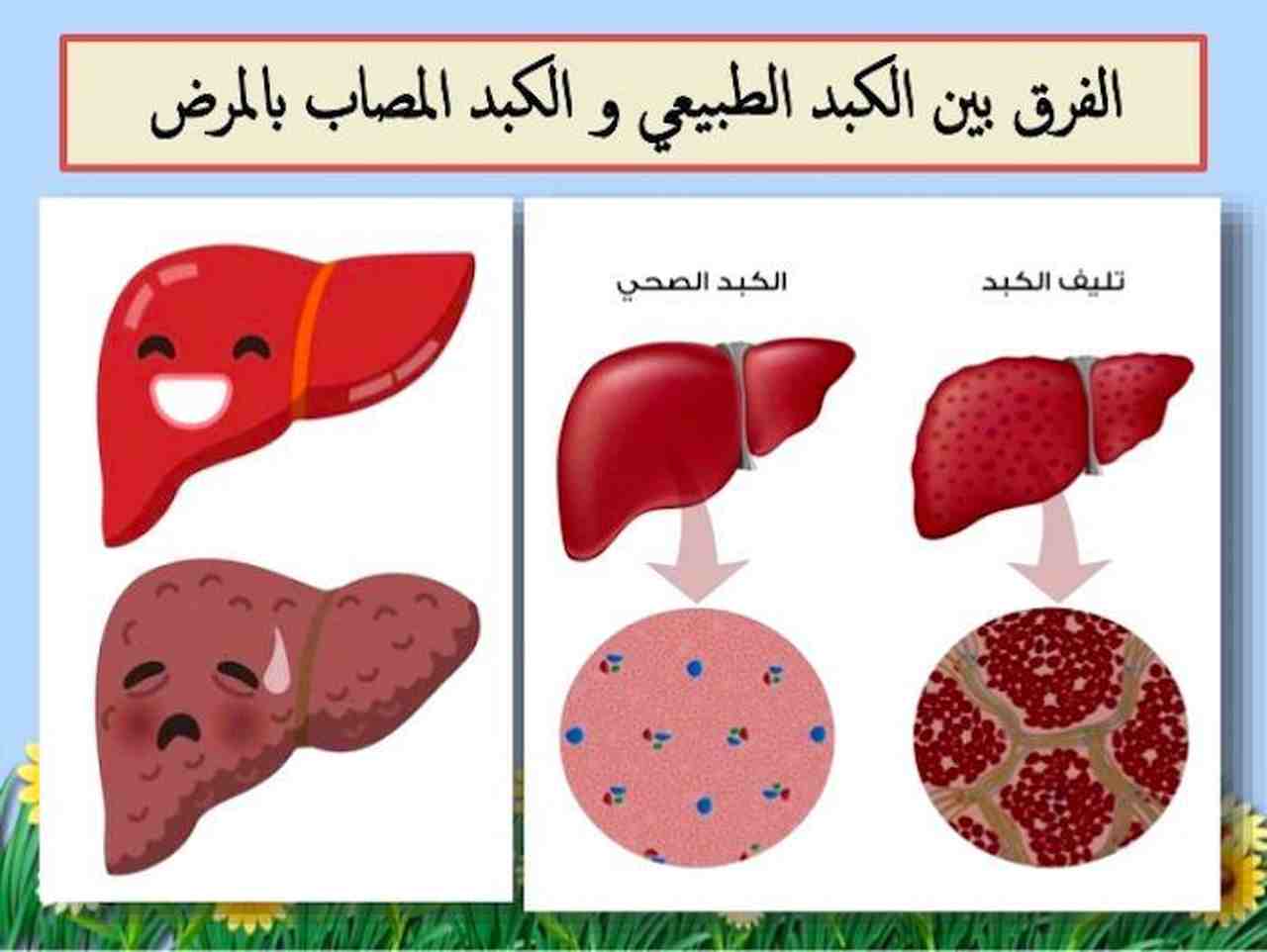 مرض الكبد الوبائي- علاج مرض الكبد 274 1