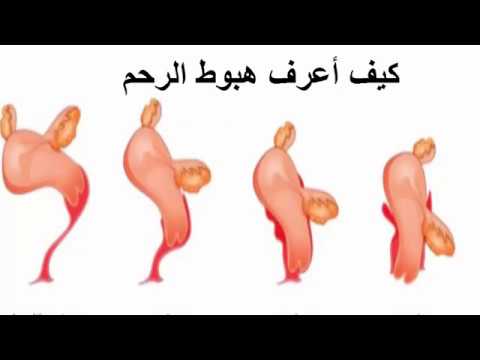 بالصور نزول الرحم - الرحم الهابط ومعرفته بالصور 12493 13