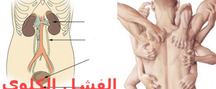 اعراض الفشل الكلوي , اسباب الفشل الكلوي واعراضه وعلاجه