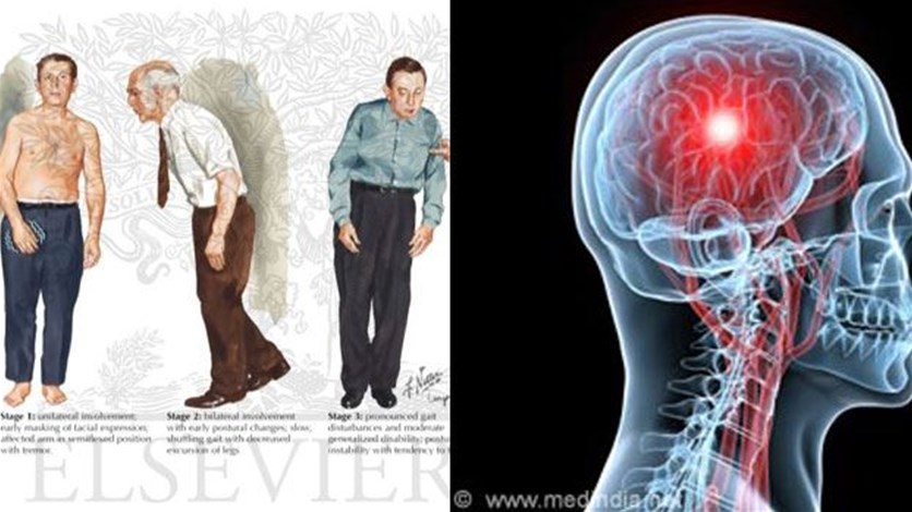 مرض باركنسون - شرح وتفاصيل مرض باركنسون 1291 1