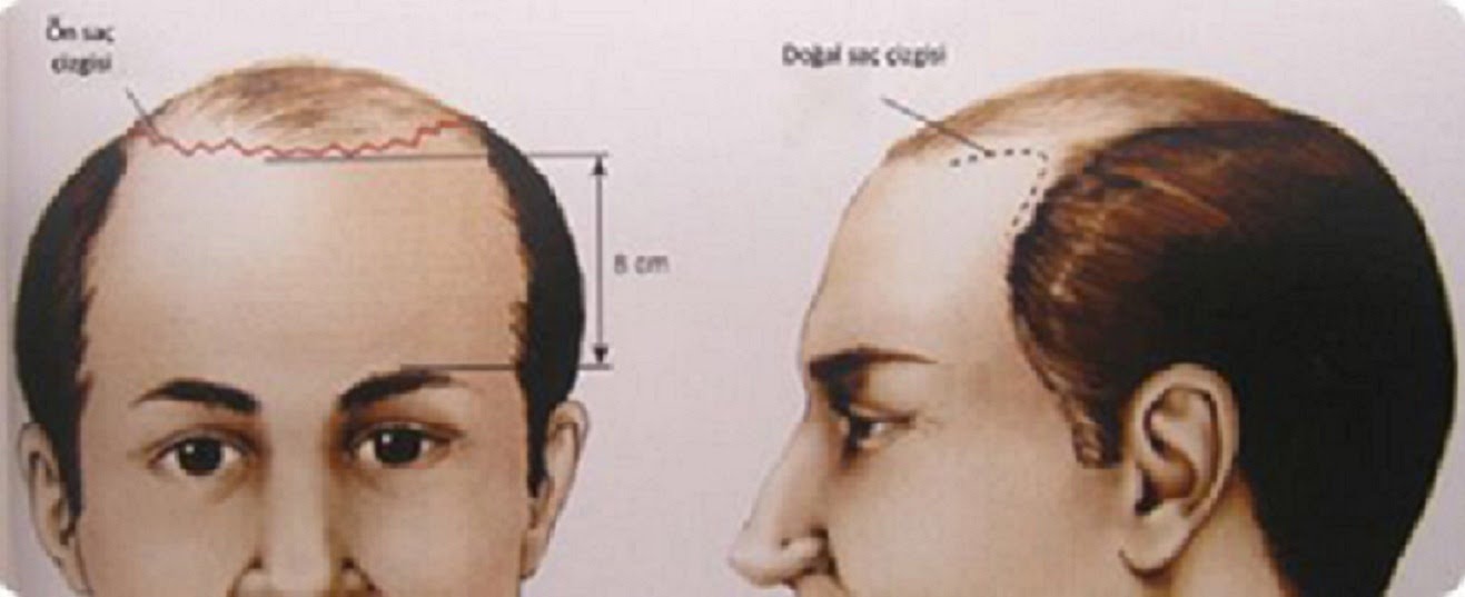 Сила лоб. Лобная линия роста волос. Типы линии роста волос у мужчин.